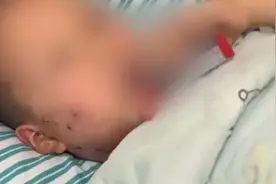 被邻居放炮炸伤截肢男孩母亲发声：治疗花销很大，怕拿不到赔偿视频封面