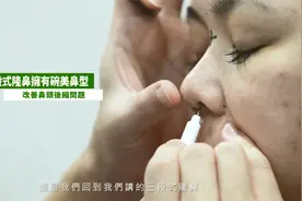 阿姨隆鼻术前到术后全记录，30天鼻头一直不消肿，恢复后超自然！视频封面
