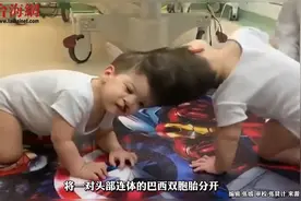 巴西头颅连体双胞胎男孩成功分离视频封面