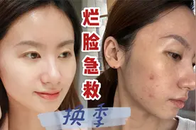 换季爆痘不要怕！烂脸修复攻略～视频封面