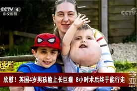欣慰！英国4岁男孩脸上长巨瘤 8小时术后终于能行走视频封面