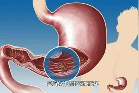 胃黏膜是保护胃部的一道屏障，修复胃黏膜的方法要学会用视频封面