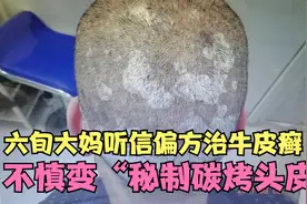 六旬大妈仙人掌煎药涂头，不慎变“秘制炭烤头皮”，吓跑广场舞伴视频封面