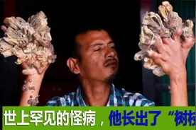 突然被怪病缠身，长出奇怪物质，人们称他“树人”，他还能治好吗视频封面