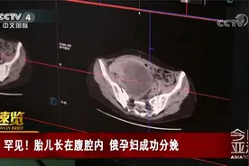 罕见！胎儿长在腹腔内 孕妇通过剖腹产成功分娩视频封面