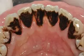 千万不要花钱买罪受！掌握这几个方法，在家就能清除烟渍口臭！视频封面