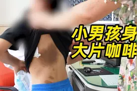 小男孩身上出现大片牛奶咖啡斑，如何治疗仍然是一大医学难题视频封面