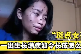 她一出生长满500颗痣，曾经被称作“斑点女孩”，如今长成怎么样视频封面