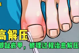 小美洗澡时发现脚趾嵌甲，急忙找修脚师治疗，过程治愈解压！视频封面