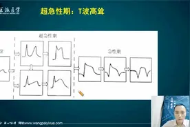 心电图考点最后冲刺：ST段抬高心电图的表现和急性心肌梗死并发症视频封面