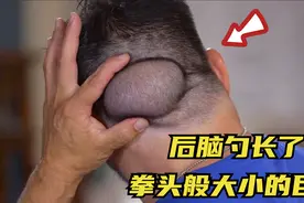 男子后脑勺长了个巨包，竟有拳头般大小，最后挤出来太解压了视频封面