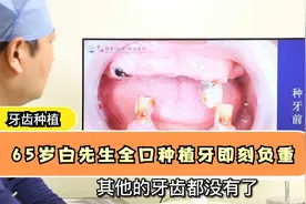 65岁只剩3颗牙，戴活动假牙不得劲！医生：全拔掉做全口种植牙视频封面