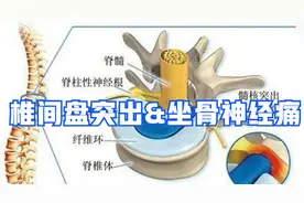 别再说椎间盘突出和坐骨神经痛是一回事了，他们还是有区别的视频封面