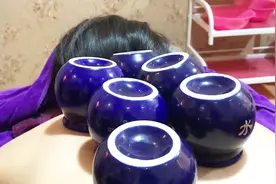 农村小妹体验中国传统拔罐，背后发紫疼的直呼受不了！视频封面