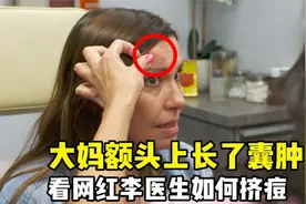 大妈额头上长了个囊肿，看网红李医生如何挤痘痘，实在是太解压了视频封面