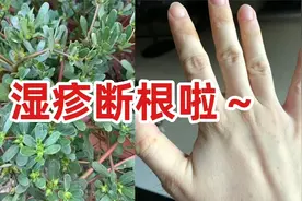 马齿苋去湿疹太牛了，直接断根啦！学会了！视频封面