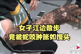 小心蛇出没 | 女子江边散步被蛇咬伤肿胀如馒头视频封面