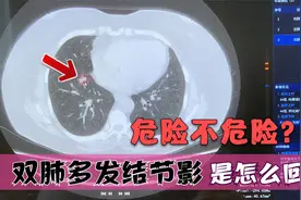 双肺多发结节影是怎么回事儿？为什么医生建议她三个月就要复查！视频封面