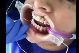 牙齿矫正的操作流程，确实很神奇视频封面