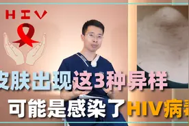 皮肤出现这3种异样，不仅仅是皮肤病，或是感染了HIV病毒