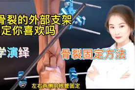 医学演绎 脚踝骨骨头断裂 你喜欢这种外部固定支架吗？看完你懂视频封面