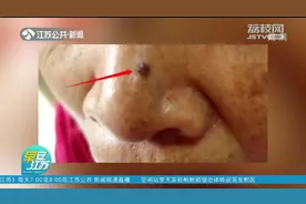 警惕！鼻头长疙瘩以为是黑头？医生紧急提醒：是癌！视频封面