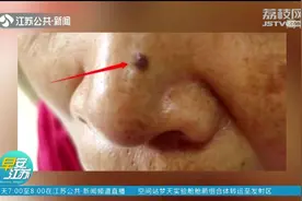 警惕！鼻头长疙瘩以为是黑头？医生紧急提醒：是癌！视频封面
