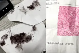 女子擦鼻涕带血，以为只是上火去医院一查被吓坏：没想到这么严重视频封面
