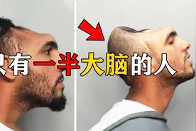 人失去一半大脑还能活吗？实际情况可能颠覆你的想象！视频封面