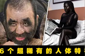6个超稀有的人体特征！96%的皮肤布满毛发，被人戏称“穴居人”！视频封面