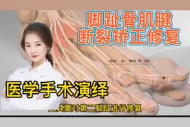 医学手术演绎  脚趾骨肌腱修复和跖骨矫正手术 看完你明白视频封面