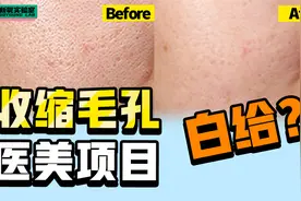 毛孔粗大怎么逆袭换皮？医美项目缩毛孔真的可行吗？