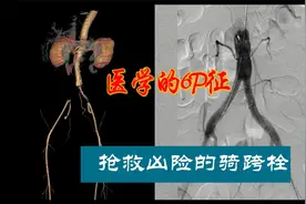 医学的6P征，一定要知道！| 抢救凶险的骑跨栓视频封面