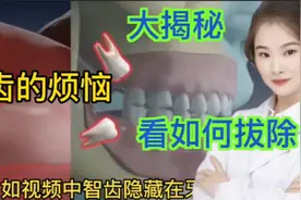 医学演绎 人体智齿疼痛 影响周边牙齿发炎臃肿 医生如何处理视频封面