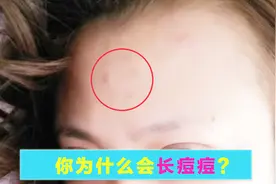 额头长痘痘如何消除，怎么去除额头上的痘痘，达人分享！