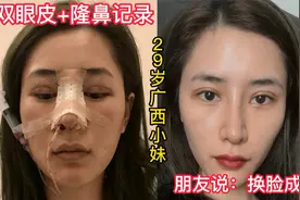 29岁广西小妹逆袭变美记录，割双眼皮耳软骨隆鼻，朋友说换脸成功视频封面
