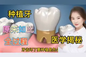 医学演绎人体种植牙全套过程是怎么样的 医生如何一步步完成种牙视频封面