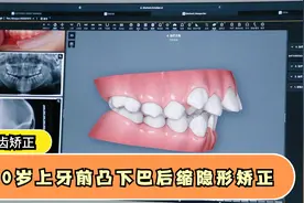 正畸方案：10岁小女孩牙齿前凸下颌后缩，隐形牙套矫正视频封面