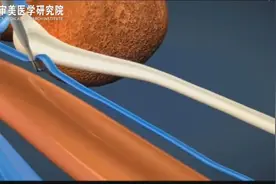 3D动画展示换肾手术全过程视频封面