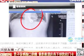 男子醉酒后胸口突感剧烈剧痛，X光结果让人大吃一惊视频封面