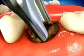 拔蛀牙到底是怎样的过程？3D动画模拟全程，看完不禁直冒冷汗视频封面