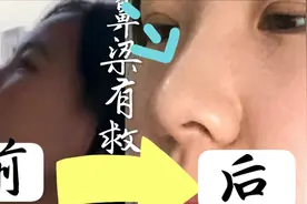 塌鼻梁蒜头鼻的留步，亲试有效不整容七天鼻梁变高的按摩方法来啦视频封面