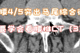 腰4/5椎间盘突出造成慢性马尾综合征，CT轴位怎么看视频封面