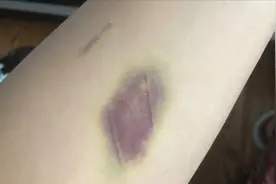 有必要表扬这个药水，磕磕绊绊有淤青也不用怕，活血化瘀家中常备视频封面