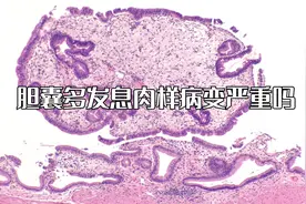 胆囊多发息肉样病变严重吗视频封面