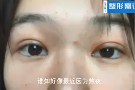 全切双眼皮恢复期记录，术后50天眼部变化完整展示，太自然了！视频封面