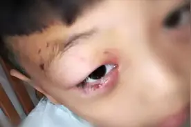 痛心！9岁孩子被狗舔伤口，一个月后?突发狂犬病，不幸死亡视频封面