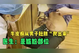 男子一掀衣服：牛皮癣从肚脐外生出“一窝虫”？医生：尴尬部位视频封面