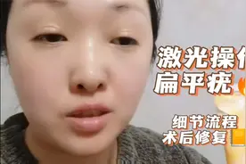 分享激光操作扁平疣的方法流程，以及术后修复的细节视频封面