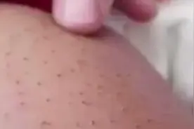 妈妈信偏方致宝宝毳毛硬如猪毛 ，医生：蛋清将毳毛粘在一起形成视频封面